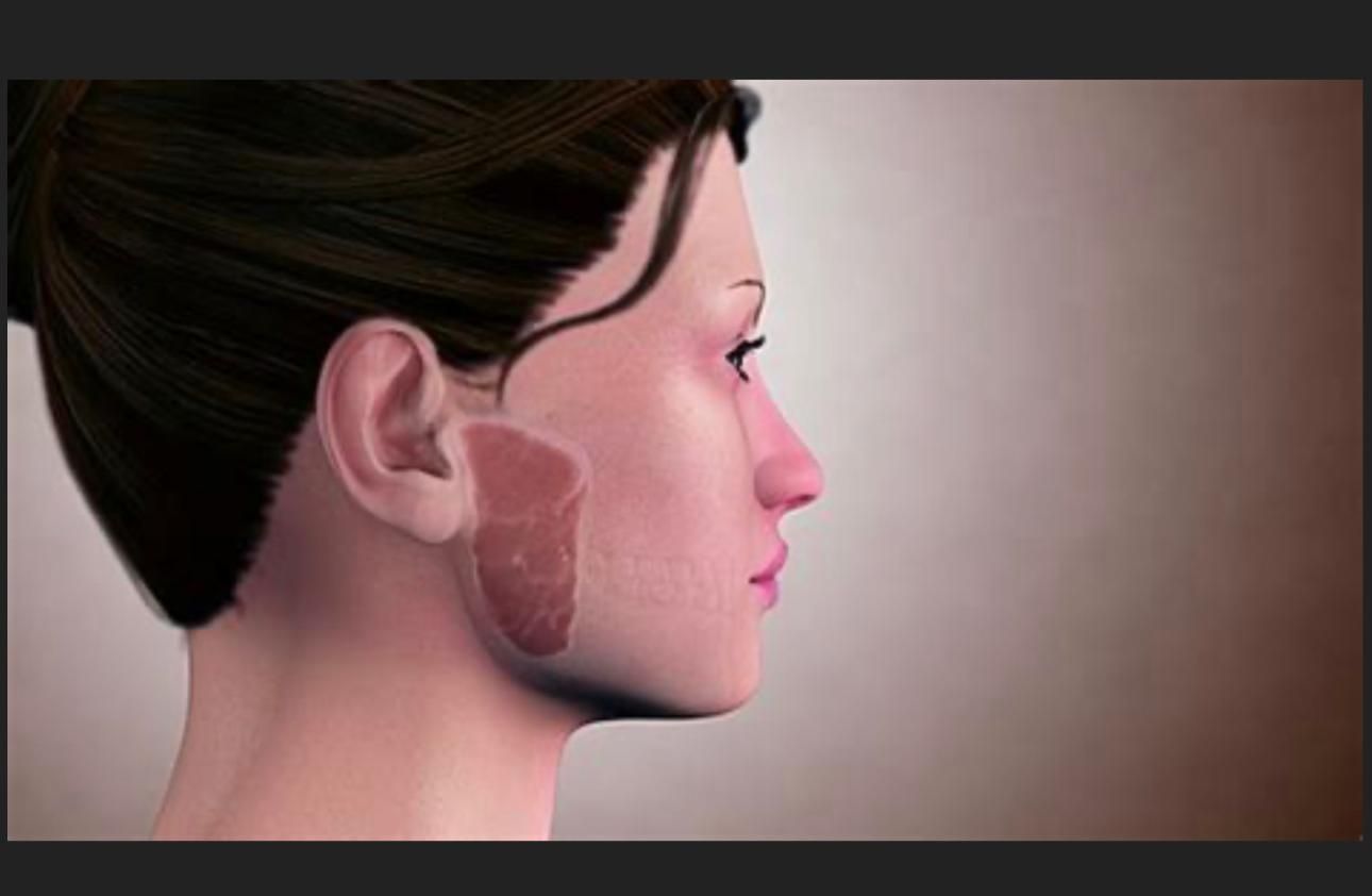Salivary Gland Tumours
